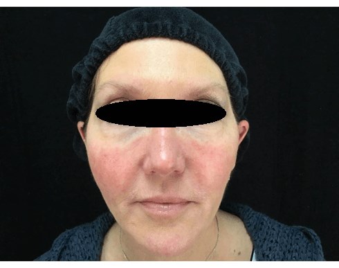 BBL for Rosacea After
