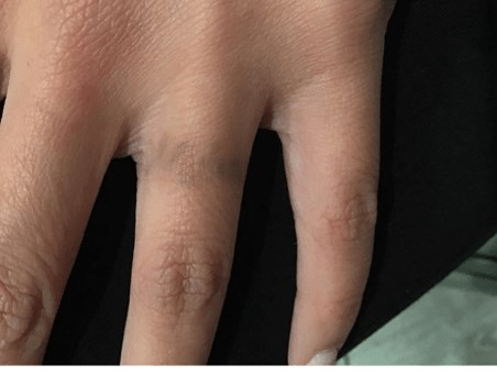 Enlighten Pico Genesis Laser After