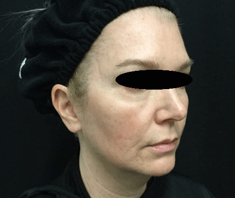 Before Image