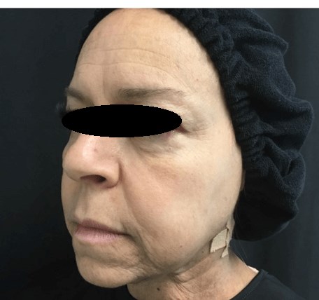 Ultherapy® treatment Before