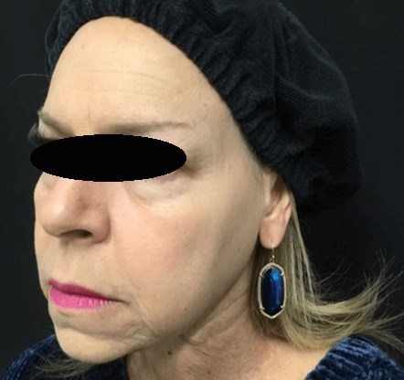 Ultherapy® treatment After