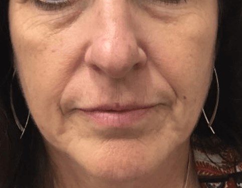 Filler and Botox Before