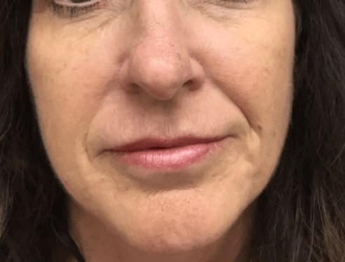 Filler and Botox After