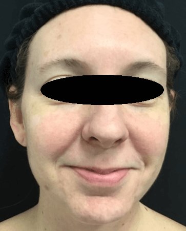Broad Band Light Laser After