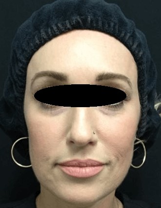 Filler and Botox After
