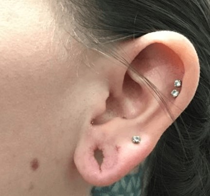 Earlobe Repair Before