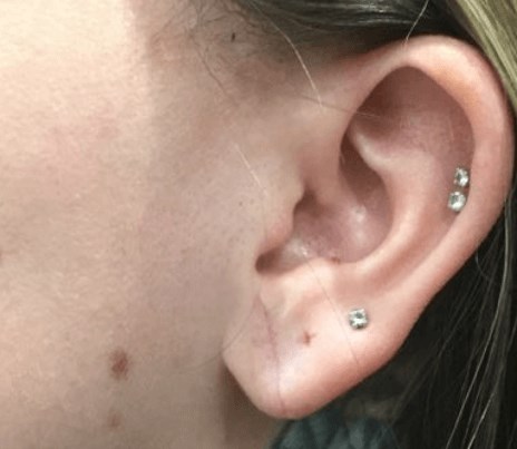 Earlobe Repair After