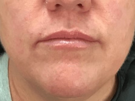 Filler before and after lips After filler