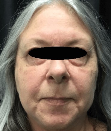 Rosacea After