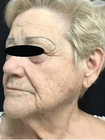Profractional/BBL treatment Before