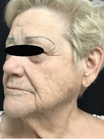 Profractional/BBL treatment Before