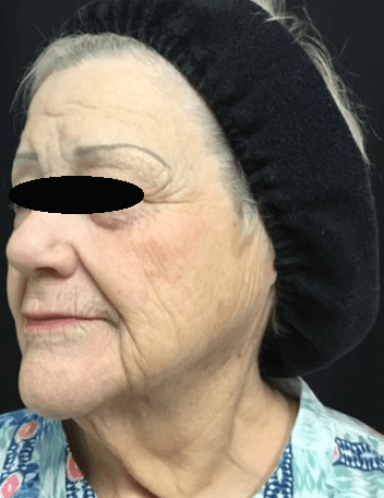 Profractional/BBL treatment After
