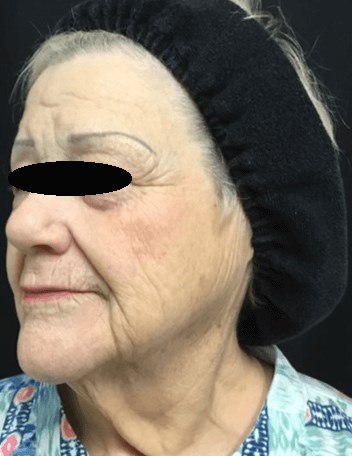 Profractional/BBL treatment After