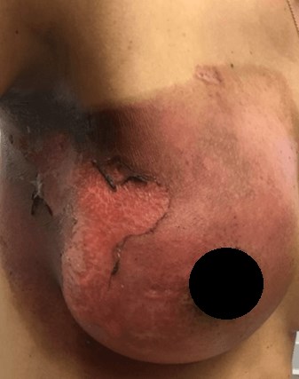 Female from Frisco, TX seeks treatment for radiation burns to the breasts