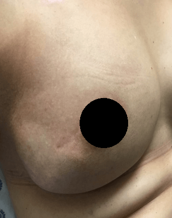 Radiation Dermatitis After