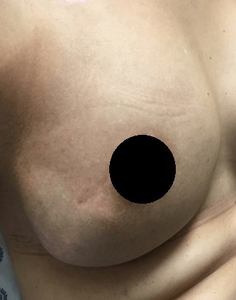 Radiation Dermatitis After